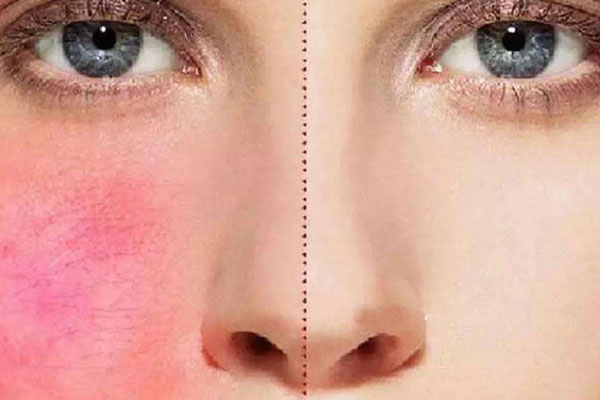 敏感肌和过敏肌的区别是什么