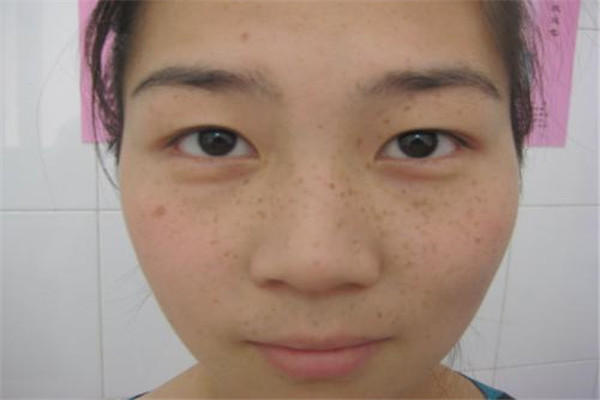 怎样祛除黄褐斑和晒斑