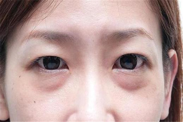 40岁女人怎么消除眼袋
