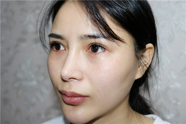 40岁女人怎么消除眼袋