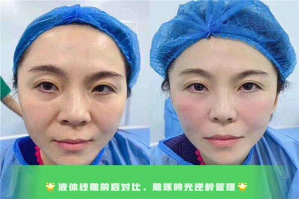 液体线雕是什么