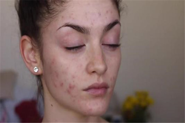 混合皮肤痘痘肌怎么护肤