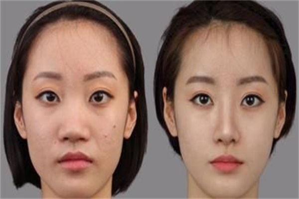 垫鼻子的副作用