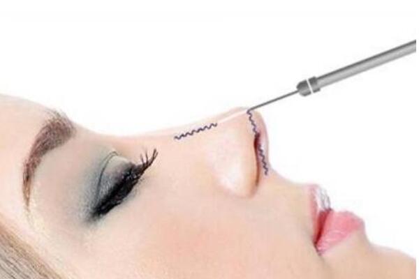 线雕鼻取出还是等吸收