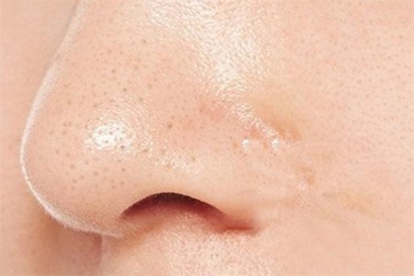 鼻子上黑头多怎么办