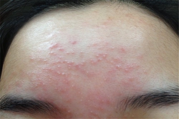 眉毛上长痘是什么原因